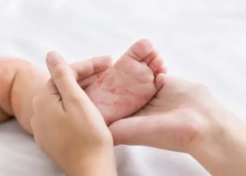 Measles warning for Cumbrian youngsters